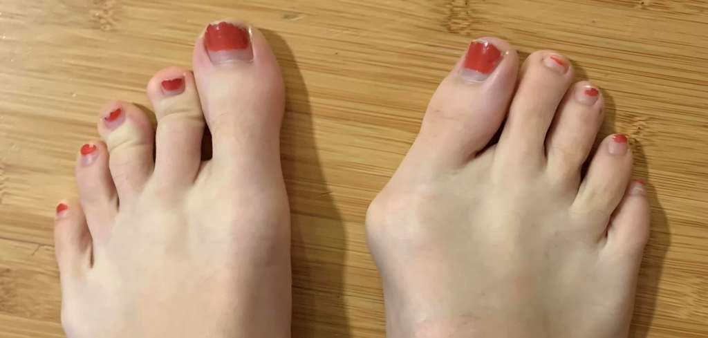 Do poorly fitting shoes cause bunions?